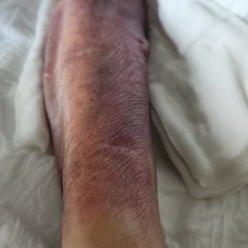 Koç Üniversitesi Hastanesi Hastaya Kötü Muamele