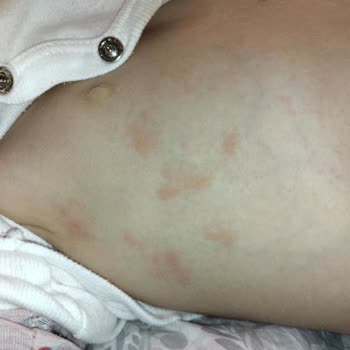 Mustela Bebek Şampuanı Bebeğimi Alerji Yaptı