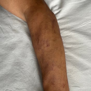 Sevim Alan Güzellik Merkezi Ataşehir Şubesi Lazer Uygulaması Sorunları