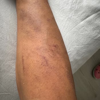 Sevim Alan Güzellik Merkezi Ataşehir Şubesi Lazer Uygulaması Sorunları