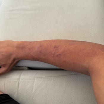 Sevim Alan Güzellik Merkezi Ataşehir Şubesi Lazer Uygulaması Sorunları