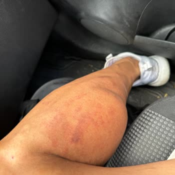 Sevim Alan Güzellik Merkezi Ataşehir Şubesi Lazer Uygulaması Sorunları