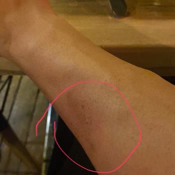 Opia Beauty Lounge Yanık Kötü Davranış Hizmet Bozukluğu