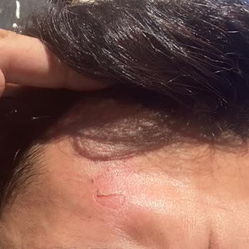 Opia Beauty Lounge Yanık Kötü Davranış Hizmet Bozukluğu