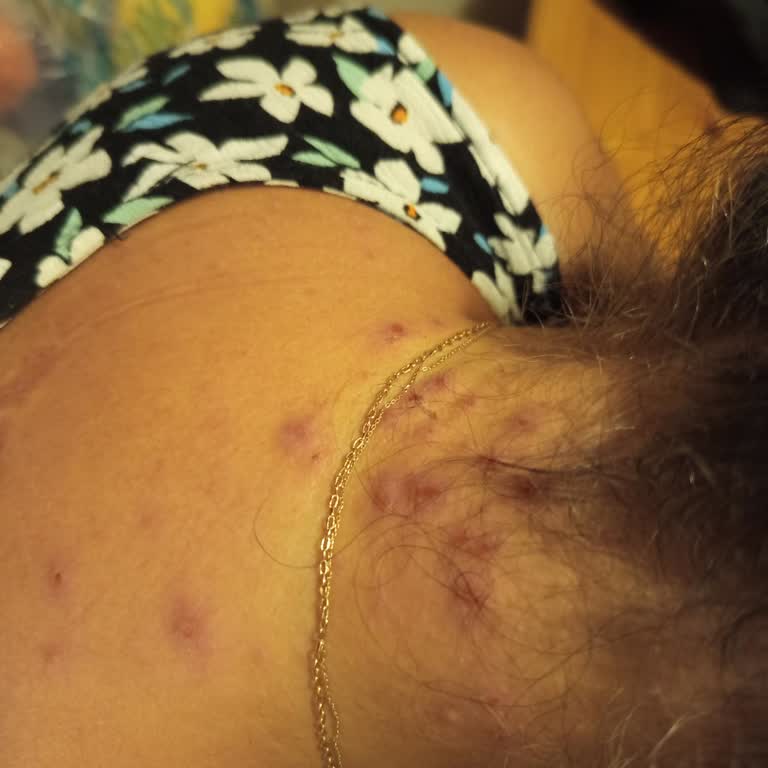 Palette Saç Boyası Kaşıntı Ve Yara Yapıyor