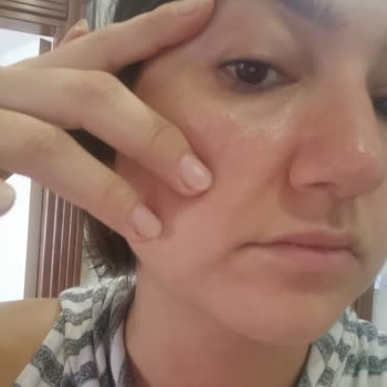 Duaderm Ürünler Alerjik Yaptı