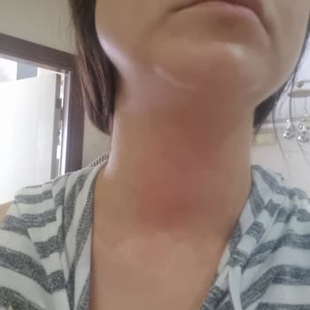 Duaderm Ürünler Alerjik Yaptı