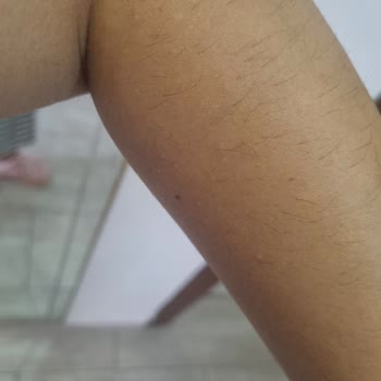 Duaderm Ürünler Alerjik Yaptı