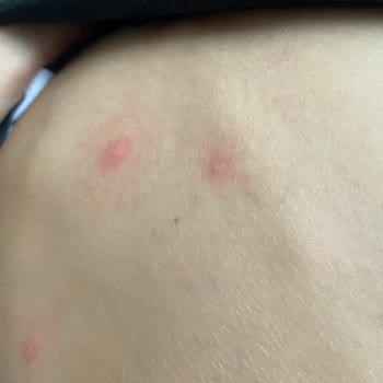 Möller's Elmalı Balık Yağı Alerjik Reaksiyona Sebep Oldu