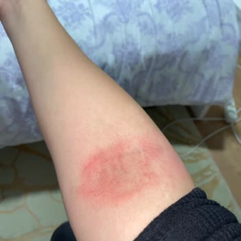 Rossmann Isana %10 Üre Krem Alerjisi