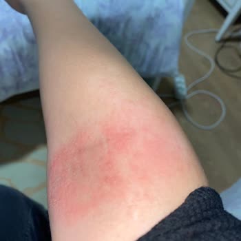 Rossmann Isana %10 Üre Krem Alerjisi