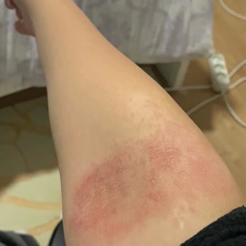 Rossmann Isana %10 Üre Krem Alerjisi