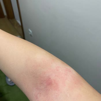 Rossmann Isana %10 Üre Krem Alerjisi