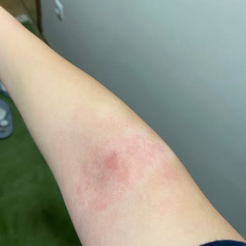 Rossmann Isana %10 Üre Krem Alerjisi