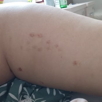 Enza Güzellik Merkezleri Özensiz Hizmet Ve Yanıklarla Sonuçlanan Lazer Epilasyon Deneyimi