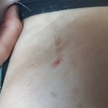 Enza Güzellik Merkezleri Özensiz Hizmet Ve Yanıklarla Sonuçlanan Lazer Epilasyon Deneyimi