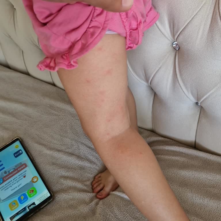 Enterogermina Çocuğumda Kaşıntı Ve Alerji Yapan Ürün