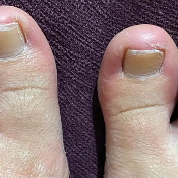 Tedi Foot Peeling Ayak Maskesi Hayatımı Zehir Etti!