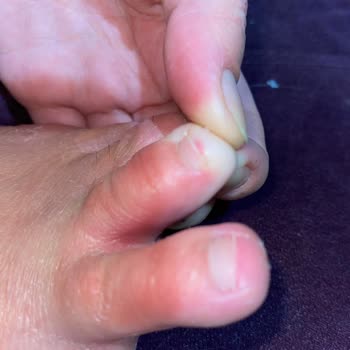 Tedi Foot Peeling Ayak Maskesi Hayatımı Zehir Etti!