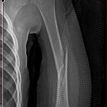 Erdem Hastanesi Doktor Saklaması Ve Yanlış Alçı Uygulaması