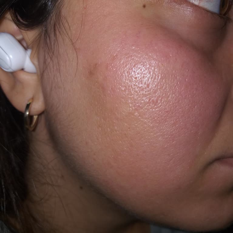 Eyüp Sabri Tuncer Gülsuyu Cildimde Kızarıklık ve Tahriş Yaptı