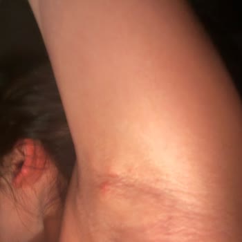 Rexona Roll On Kullanımı Sonrası Şiddetli Ağrı ve Kistik Bezeler