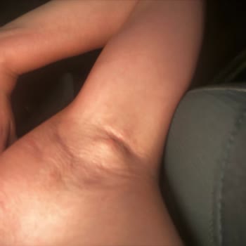 Rexona Roll On Kullanımı Sonrası Şiddetli Ağrı ve Kistik Bezeler