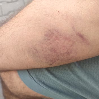 Türk Kızılay Kan Bağışı Sonrası Yaşadığım Ağrı Ve Morluk Sorunu