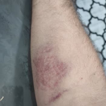 Türk Kızılay Kan Bağışı Sonrası Yaşadığım Ağrı Ve Morluk Sorunu