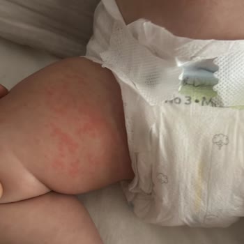 Mustela Nemlendirici Vücut Losyonu Cilt Reaksiyonu