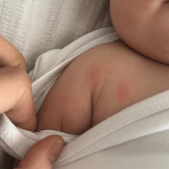 Mustela Nemlendirici Vücut Losyonu Cilt Reaksiyonu