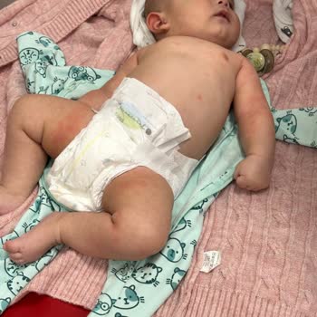 Mustela Nemlendirici Vücut Losyonu Cilt Reaksiyonu