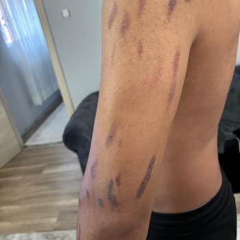 Deluxe Vip Güzellik Merkezi Yanıklarla Sonuçlanan Güzellik Merkezi Deneyimi