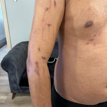 Deluxe Vip Güzellik Merkezi Yanıklarla Sonuçlanan Güzellik Merkezi Deneyimi