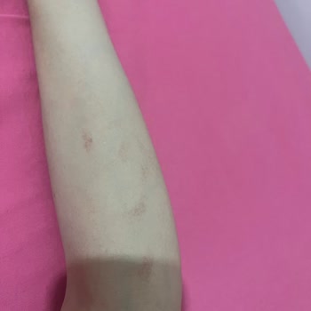 Lazer Cihazı Yanık ve İade Sorunu