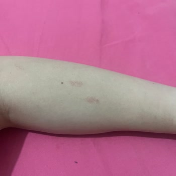 Lazer Cihazı Yanık ve İade Sorunu