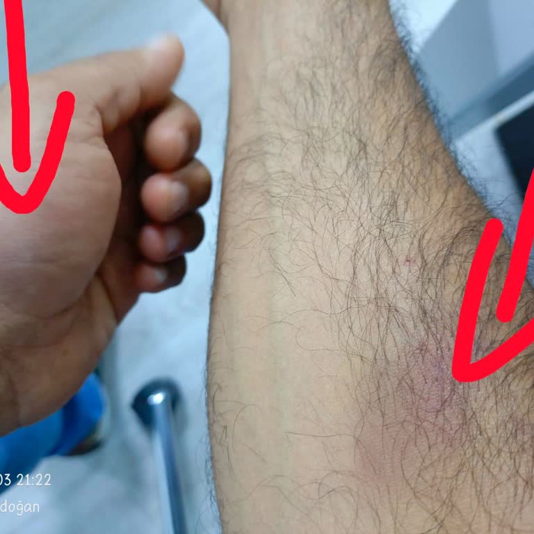 Fonksera'nın Yan Etkileri: Morluklar ve Kaşıntılar