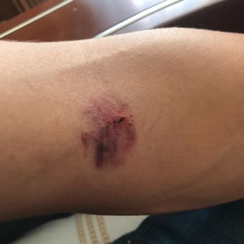 Türk Kızılay 'a Kan Bağışı Sonrası Yaşanan Kol Sakatlığı Ve Mağduriyet