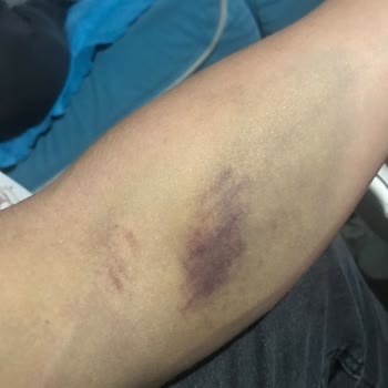 Türk Kızılay 'a Kan Bağışı Sonrası Yaşanan Kol Sakatlığı Ve Mağduriyet