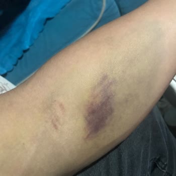 Türk Kızılay 'a Kan Bağışı Sonrası Yaşanan Kol Sakatlığı Ve Mağduriyet