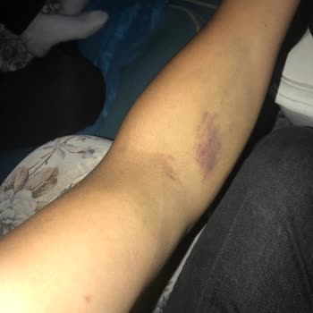 Türk Kızılay 'a Kan Bağışı Sonrası Yaşanan Kol Sakatlığı Ve Mağduriyet