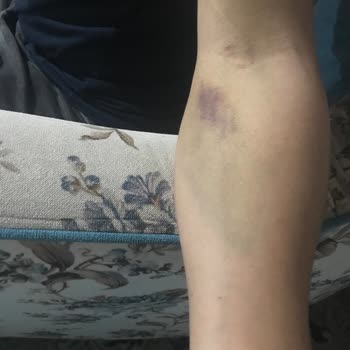 Türk Kızılay 'a Kan Bağışı Sonrası Yaşanan Kol Sakatlığı Ve Mağduriyet