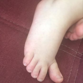 Klamoks Şurubu Kullanımı Sonrası Ciltte Kızarıklık Sorunu