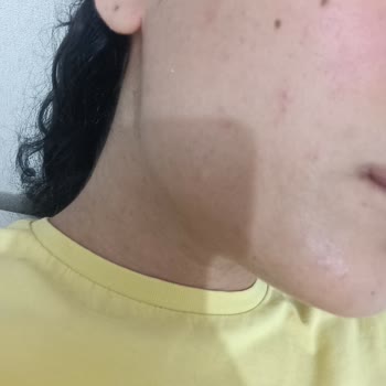 Sebamed 50+ SPF Sun Cream Caused Redness and Acne, Requesting Refund