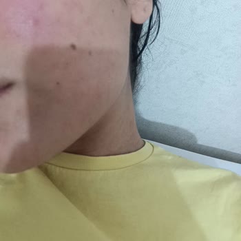 Sebamed 50+ SPF Sun Cream Caused Redness and Acne, Requesting Refund