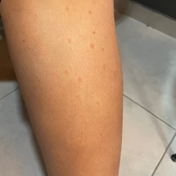 Lazer Epilasyon Seanslarında Hayal Kırıklığı ve Yanıklar