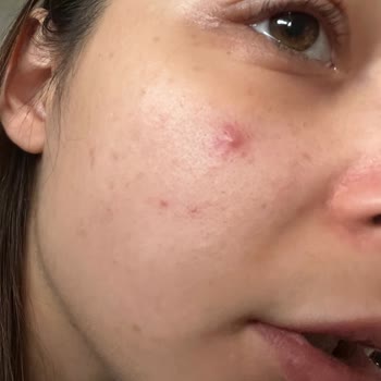 Alerji ve Ağrılı Sivilceler: Trendyol'dan Aldığım Ürün Sorunu