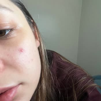 Alerji ve Ağrılı Sivilceler: Trendyol'dan Aldığım Ürün Sorunu