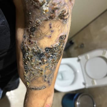 Tatto Ozan Ünsal Acılı İşlemler Ve Yanıklar