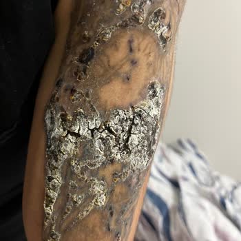 Tatto Ozan Ünsal Acılı İşlemler Ve Yanıklar